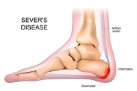 How Sever’s Disease Affects Children